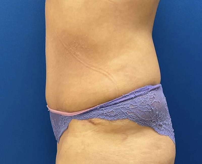 Liposuction Before & After Gallery - Patient 95447445 - Image 6