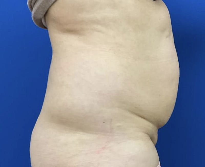 Liposuction Before & After Gallery - Patient 95447445 - Image 3