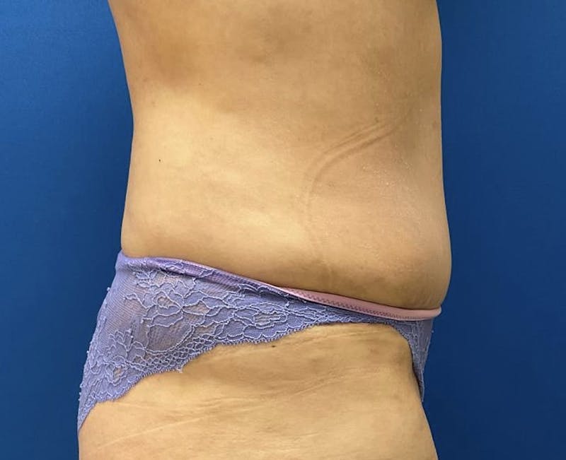 Liposuction Before & After Gallery - Patient 95447445 - Image 4