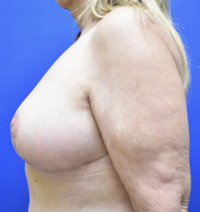 Breast Reduction Before & After Gallery - Patient 90702452 - Image 6
