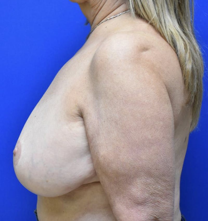 Breast Reduction Before & After Gallery - Patient 90702452 - Image 5
