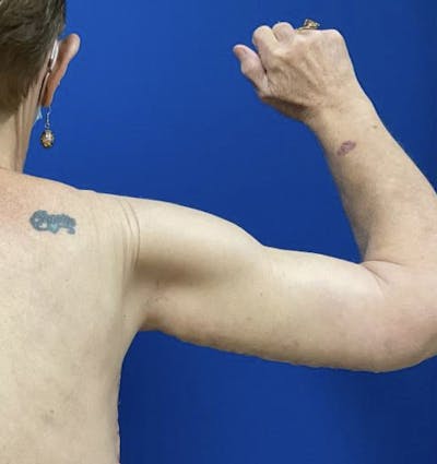 Arm Lift Before & After Gallery - Patient 90702489 - Image 2