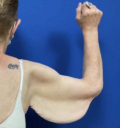 Arm Lift Before & After Gallery - Patient 90702489 - Image 1