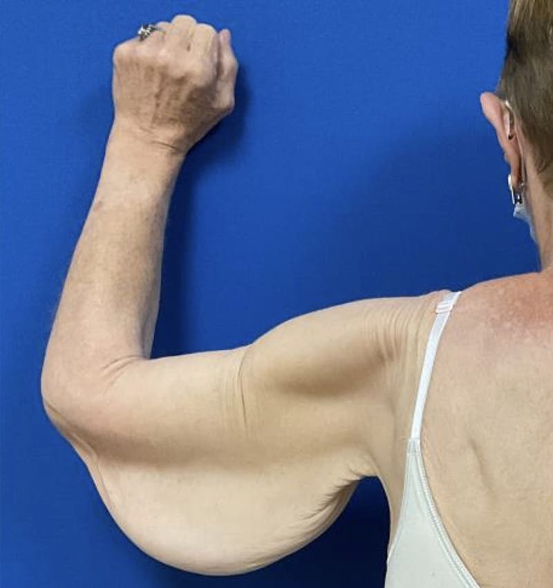 Arm Lift Before & After Gallery - Patient 90702489 - Image 3