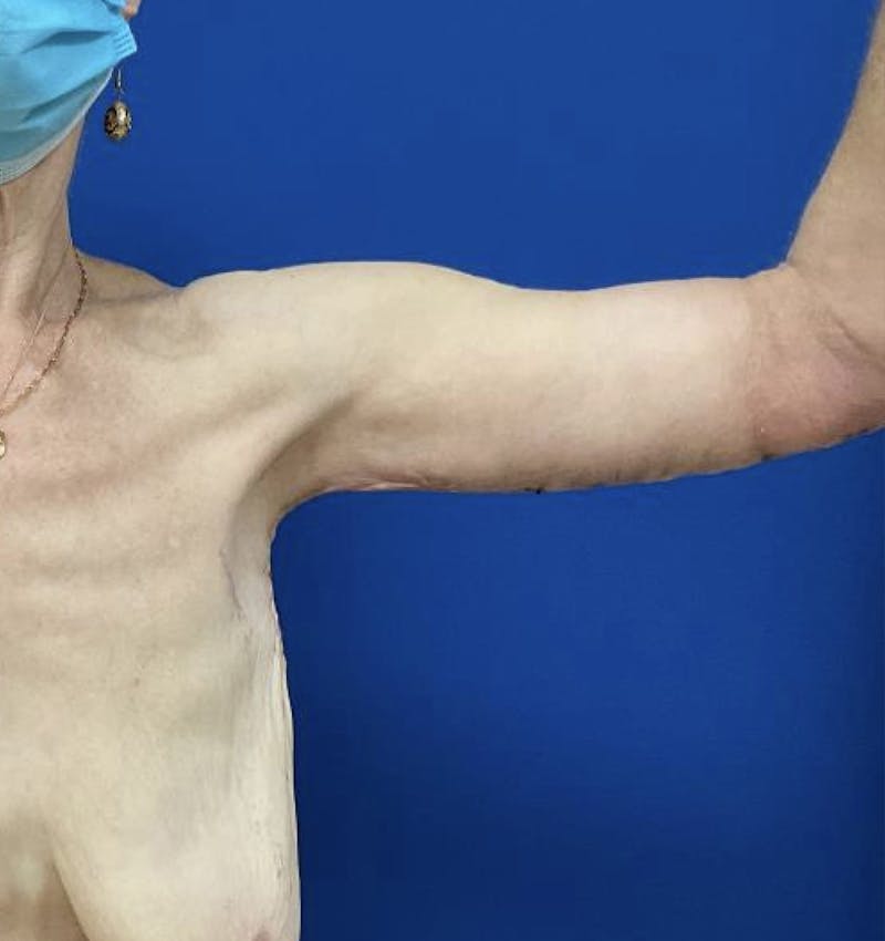 Arm Lift Before & After Gallery - Patient 90702489 - Image 6