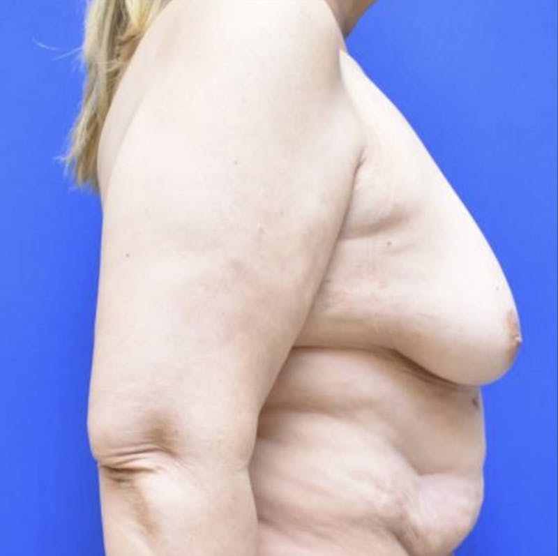 DIEP Flap Reconstruction Before & After Gallery - Patient 90702518 - Image 8