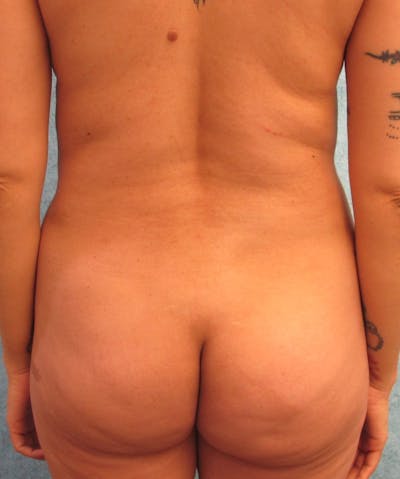 Brazilian Butt Lift Before & After Gallery - Patient 90704388 - Image 1