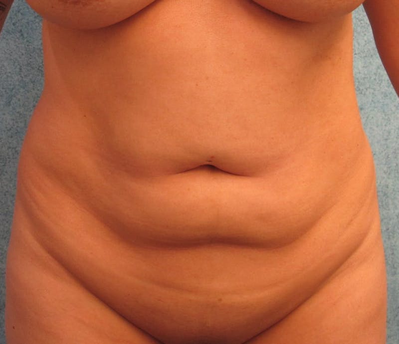 Liposuction Before & After Gallery - Patient 95447543 - Image 1