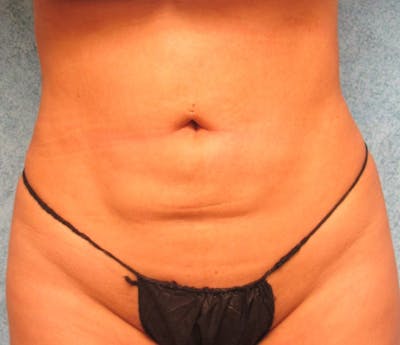 Liposuction Before & After Gallery - Patient 95447543 - Image 2
