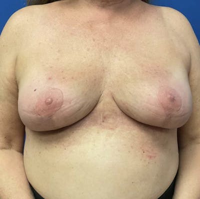 Breast Lift Before & After Gallery - Patient 90704556 - Image 2