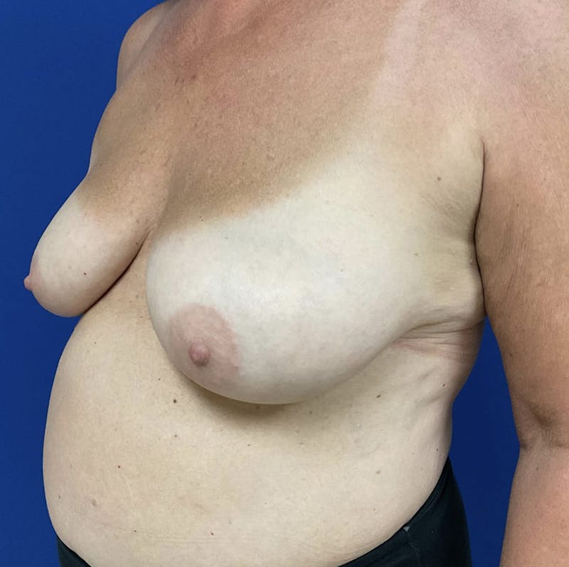 Breast Lift Before & After Gallery - Patient 90704556 - Image 3