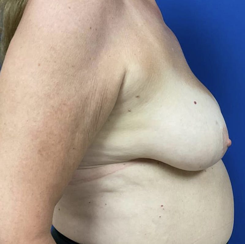 Breast Lift Before & After Gallery - Patient 90704556 - Image 5