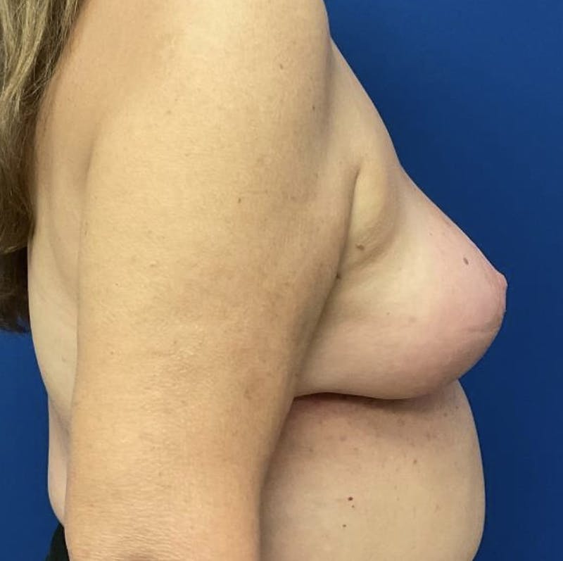 Breast Lift Before & After Gallery - Patient 90704556 - Image 6