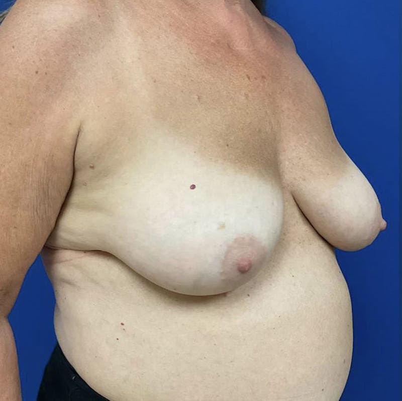 Breast Lift Before & After Gallery - Patient 90704556 - Image 7