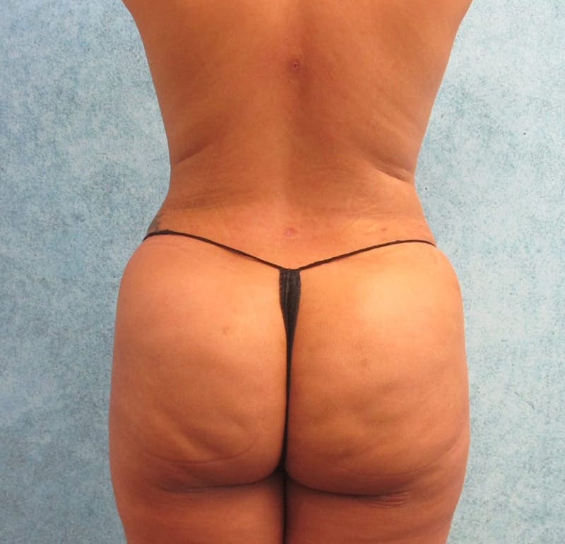 Liposuction Before & After Gallery - Patient 90702371 - Image 8
