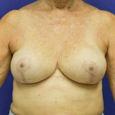 Breast Reduction Before & After Gallery - Patient 90704314 - Image 2