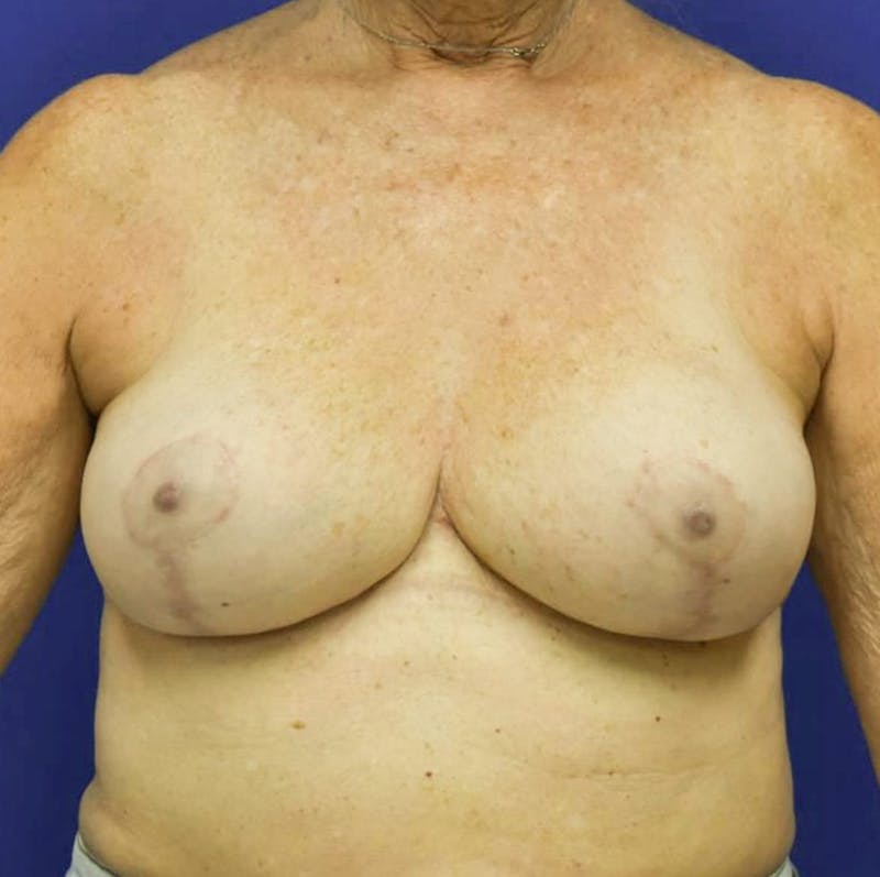 Breast Reduction Before & After Gallery - Patient 90704314 - Image 2