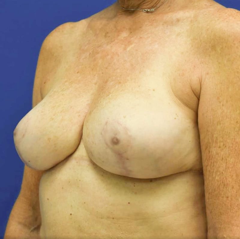 Breast Reduction Before & After Gallery - Patient 90704314 - Image 4