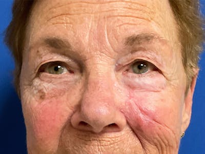 Mohs Reconstruction Before & After Gallery - Patient 129433413 - Image 2