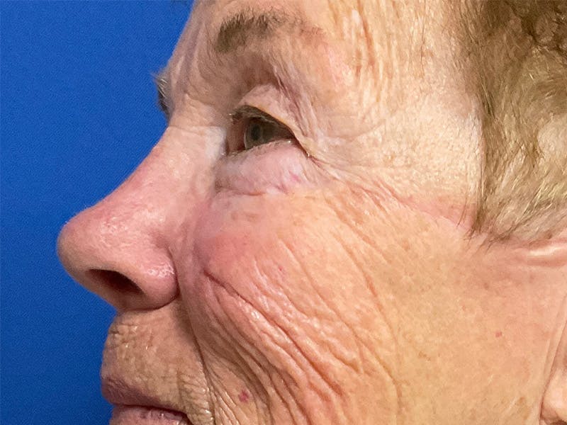 Mohs Reconstruction Before & After Gallery - Patient 129433413 - Image 4