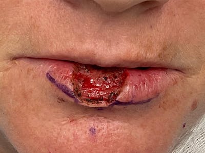 Mohs Reconstruction Before & After Gallery - Patient 129499499 - Image 1