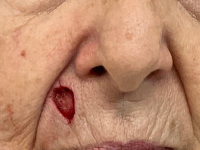 Mohs Reconstruction Before & After Gallery - Patient 129499497 - Image 1