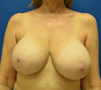 Breast Implant Removal Before & After Gallery - Patient 132817501 - Image 1
