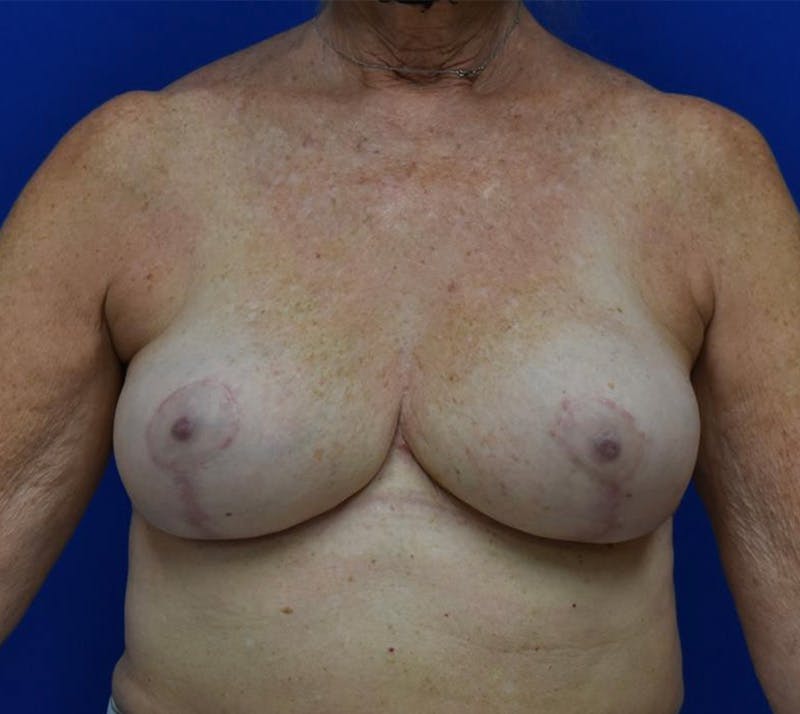 Breast Implant Removal Before & After Gallery - Patient 132817501 - Image 2