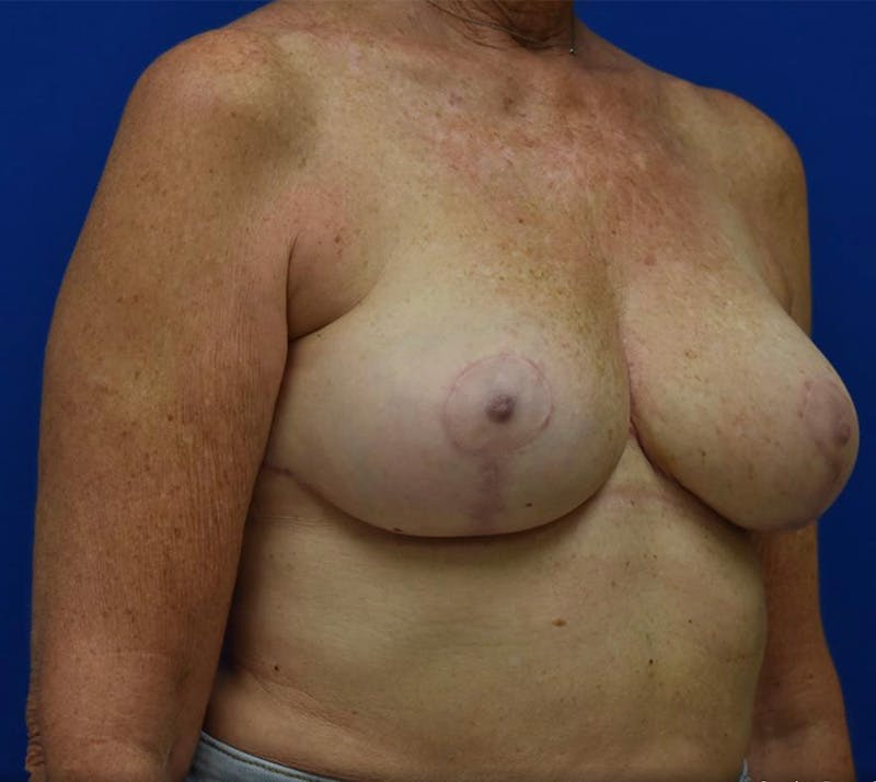 Breast Reduction Before & After Gallery - Patient 132817418 - Image 4