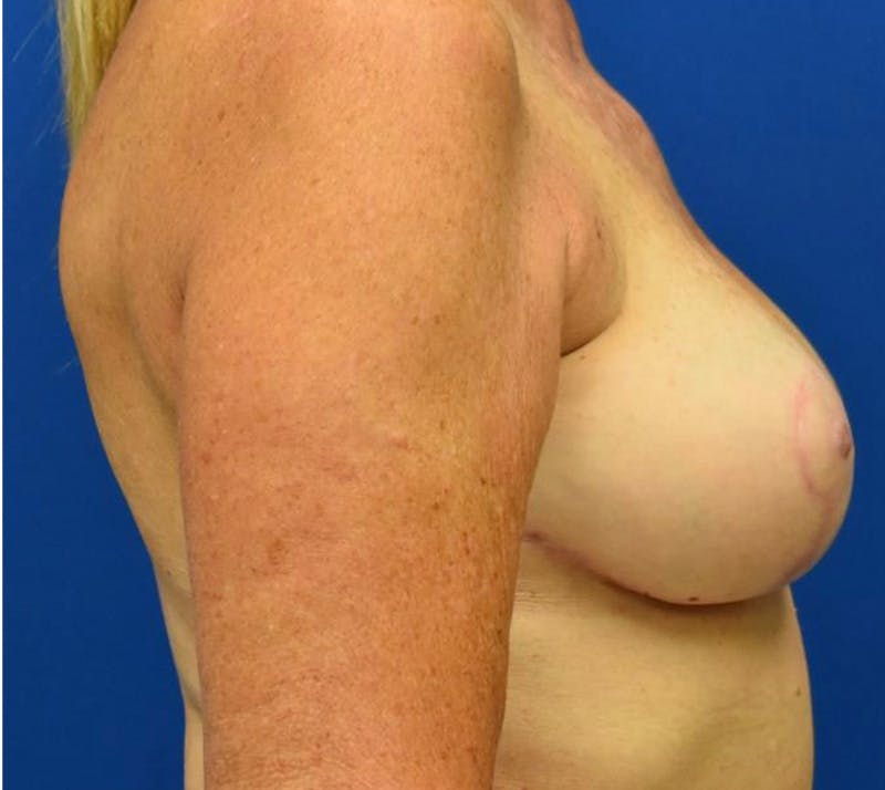 Breast Implant Removal Before & After Gallery - Patient 132817501 - Image 6