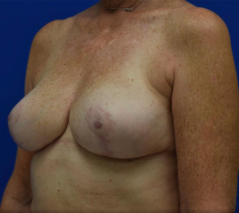 Breast Reduction Before & After Gallery - Patient 132817418 - Image 8