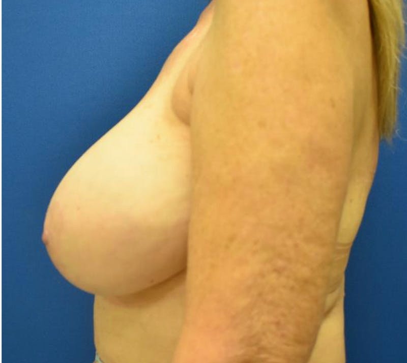 Breast Reduction Before & After Gallery - Patient 132817418 - Image 9