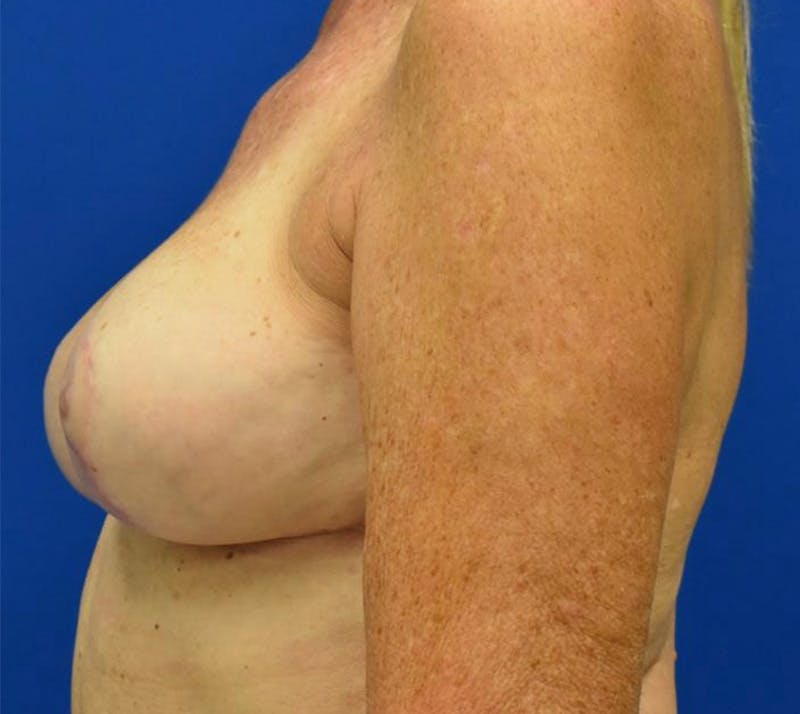 Breast Implant Removal Before & After Gallery - Patient 132817501 - Image 10