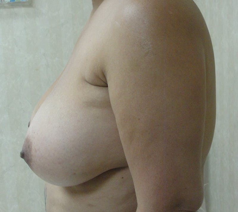 Breast Reduction Before & After Gallery - Patient 132818402 - Image 5