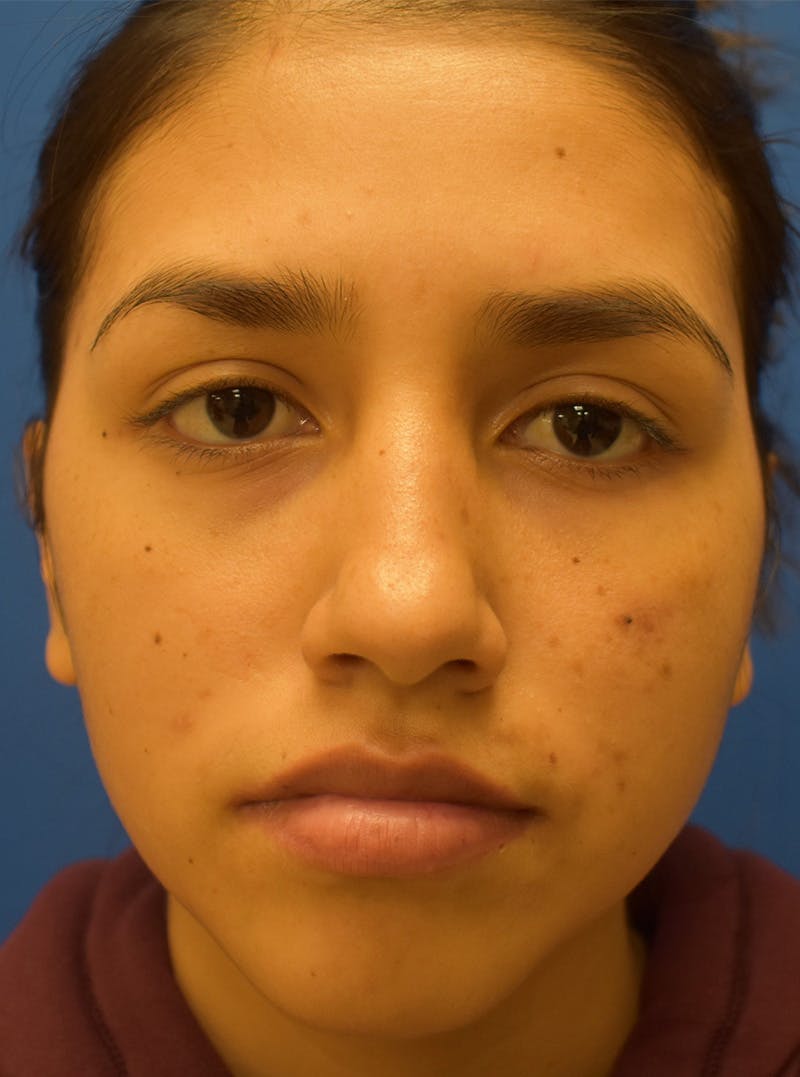 Rhinoplasty Before & After Gallery - Patient 132824299 - Image 5