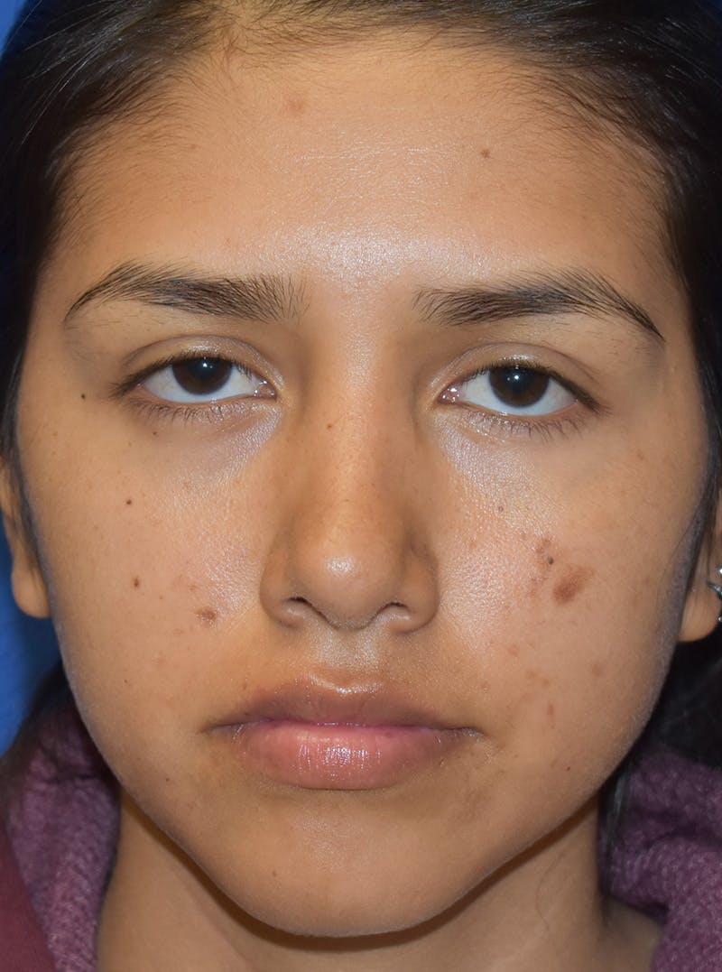 Rhinoplasty Before & After Gallery - Patient 132824299 - Image 6