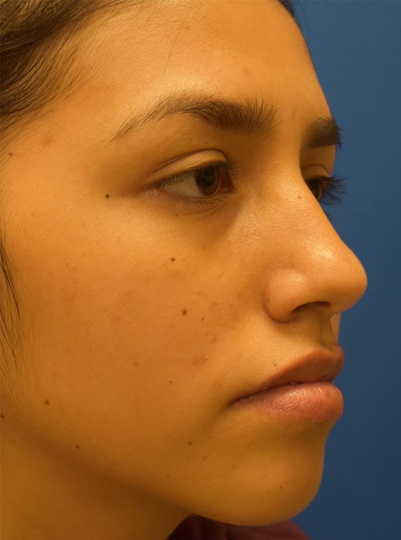 Rhinoplasty Before & After Gallery - Patient 132824299 - Image 3