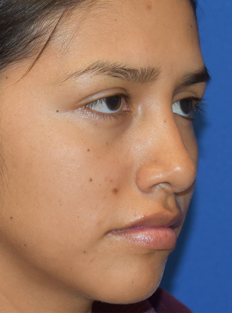 Rhinoplasty Before & After Gallery - Patient 132824299 - Image 4