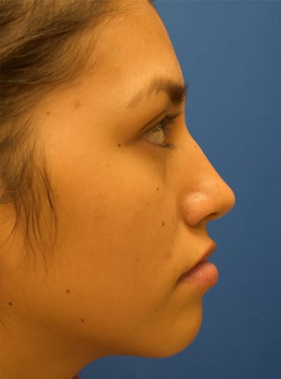 Rhinoplasty Before & After Gallery - Patient 132824299 - Image 1