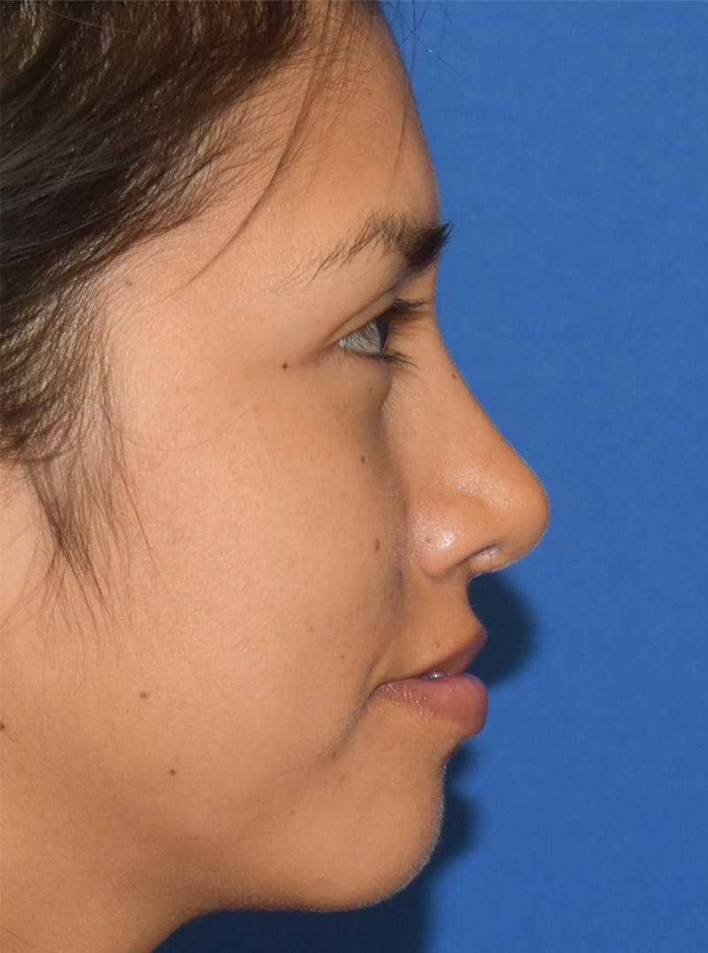 Rhinoplasty Before & After Gallery - Patient 132824299 - Image 2