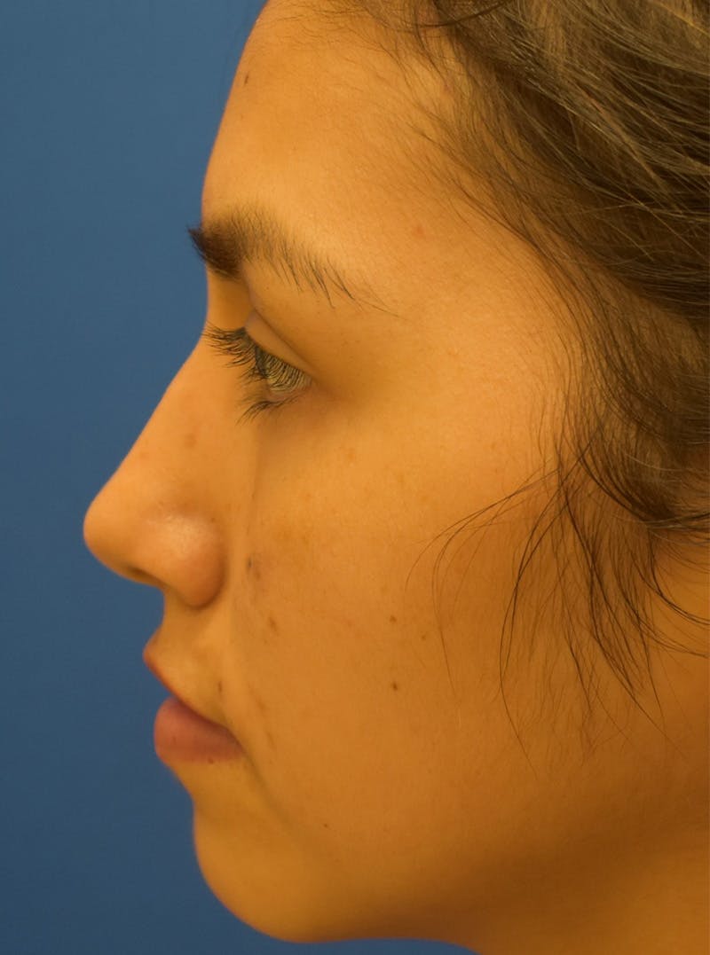 Rhinoplasty Before & After Gallery - Patient 132824299 - Image 7