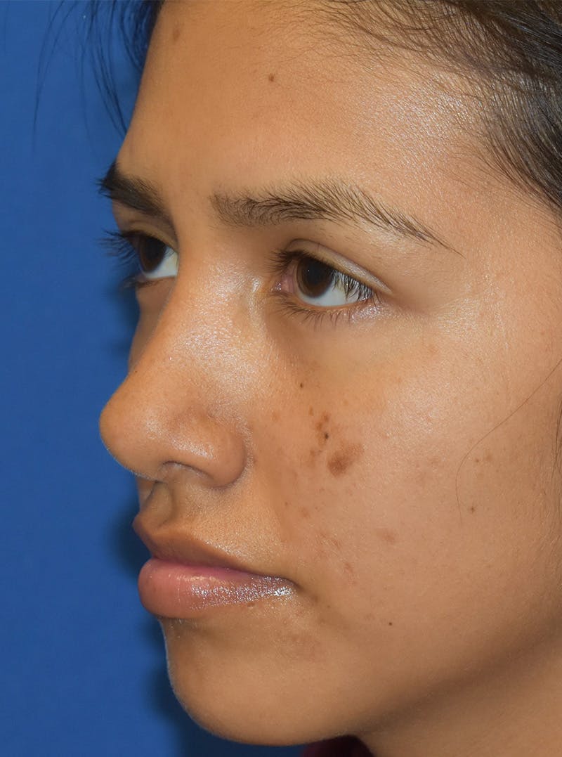 Rhinoplasty Before & After Gallery - Patient 132824299 - Image 8