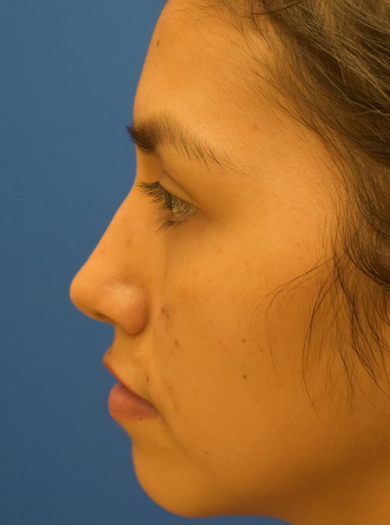 Rhinoplasty Before & After Gallery - Patient 132824299 - Image 9