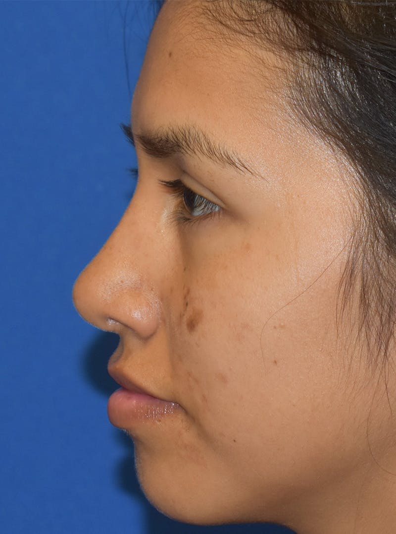 Rhinoplasty Before & After Gallery - Patient 132824299 - Image 10