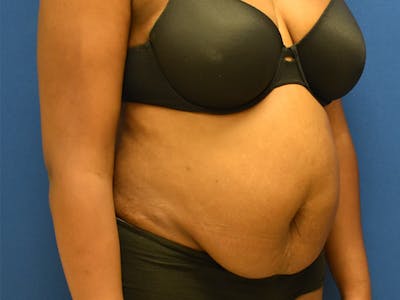 Tummy Tuck Before & After Gallery - Patient 129499488 - Image 1