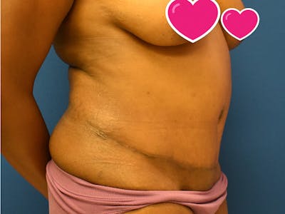 Tummy Tuck Before & After Gallery - Patient 129499488 - Image 2