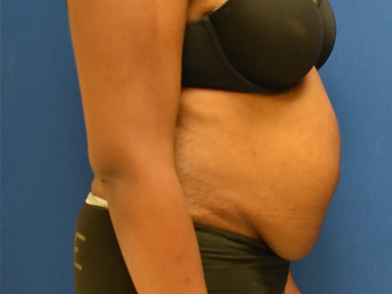 Tummy Tuck Before & After Gallery - Patient 129499488 - Image 3