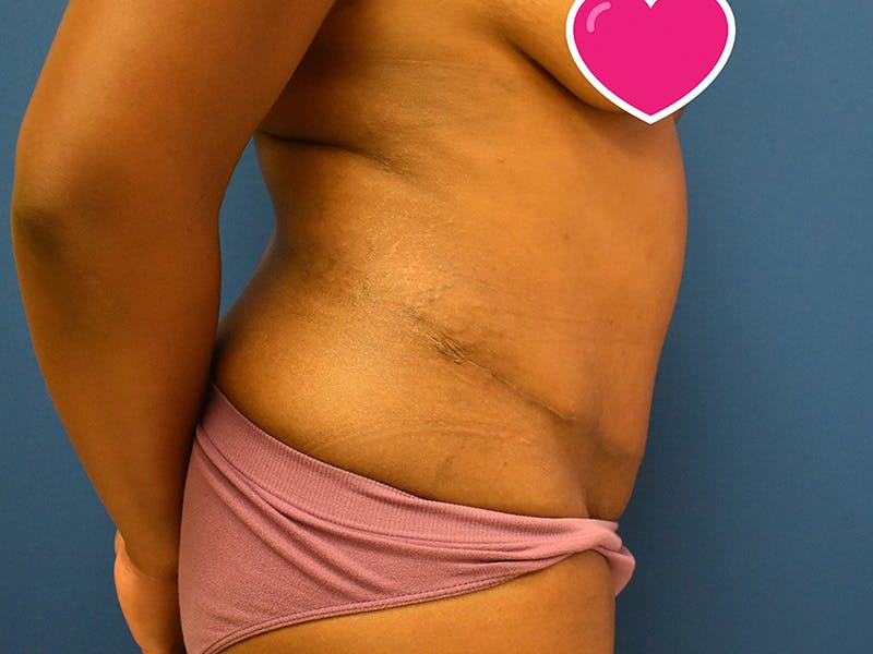 Tummy Tuck Before & After Gallery - Patient 129499488 - Image 4