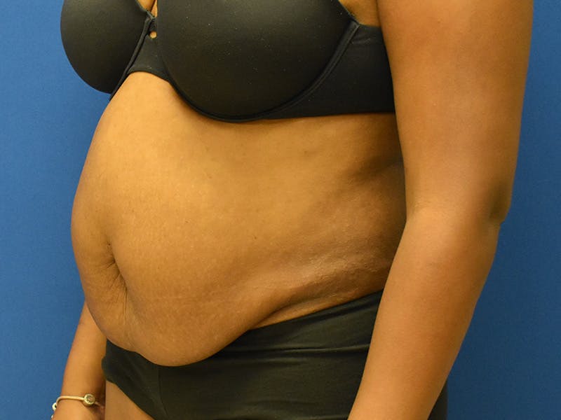 Tummy Tuck Before & After Gallery - Patient 129499488 - Image 5