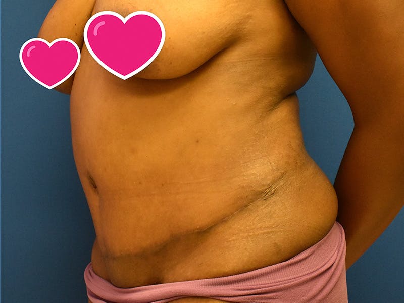 Tummy Tuck Before & After Gallery - Patient 129499488 - Image 6